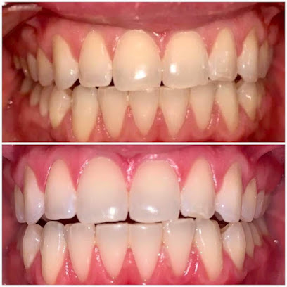 Elevation Teeth Whitening