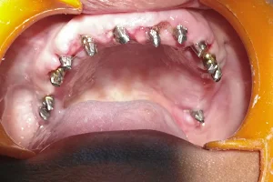 Dr.Leela Krishna Basal Implantologist |Dental Implant Clinic In Vijayawada image