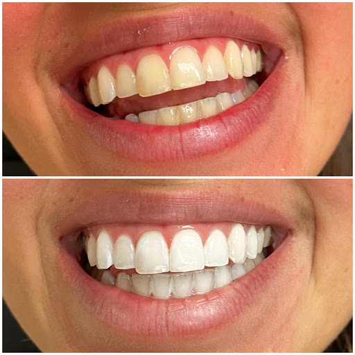 Bright White Pros Teeth Whitening