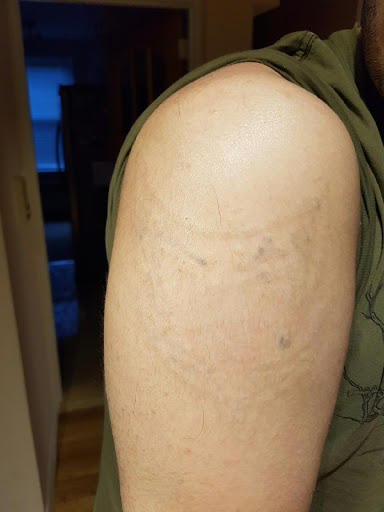 Explore tattoo ideas arm shoulder, creative tattoo ideas in Brooklyn, available at Brooklyn Laser Tattoo Removal, Inc.