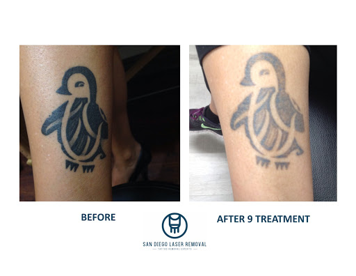 Explore playboi carti tattoo ideas, creative tattoo ideas in San Diego, available at Removery Tattoo Removal & Fading