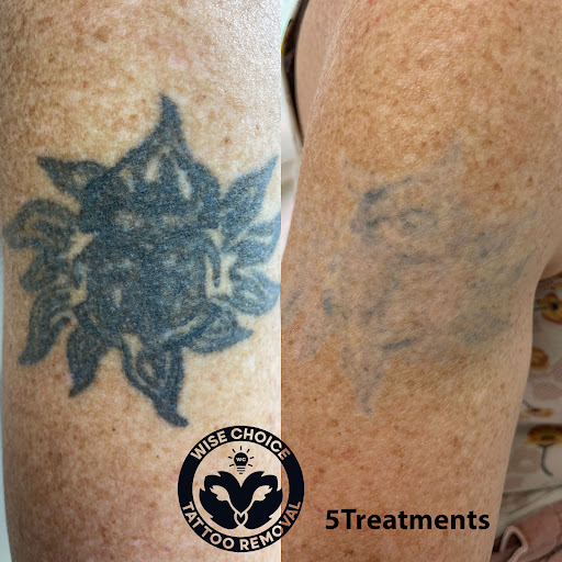 Explore ichigo tattoo ideas, creative tattoo ideas in Denver, available at Wise Choice Tattoo Removal