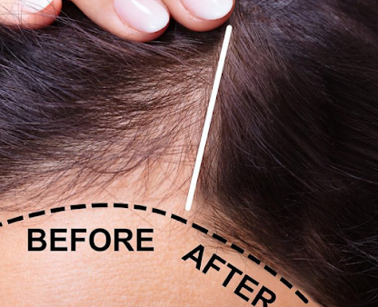 Sydney Hair Transplant Clinic - Sydney Hair Transplant Clinic