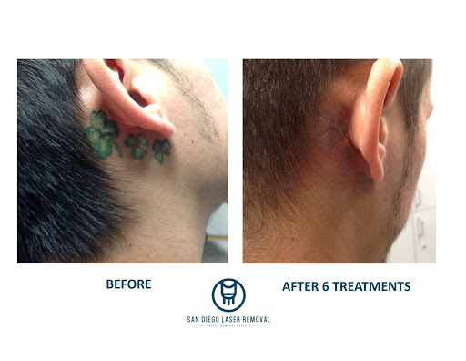 Explore tattoos for your son ideas, creative tattoo ideas in San Diego, available at Removery Tattoo Removal & Fading