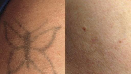 Explore playing cards tattoo ideas, creative tattoo ideas in Tempe, available at Sparkle Laser HairTattoo Removal