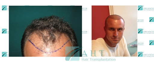 Transplantacija kose AHT