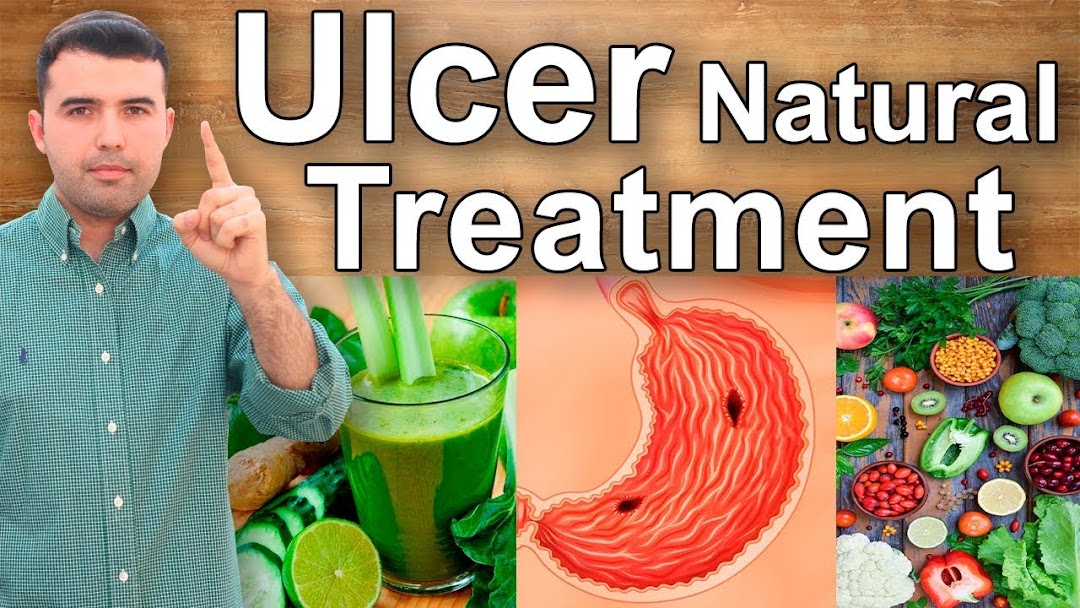 100 Ulcer Treatment