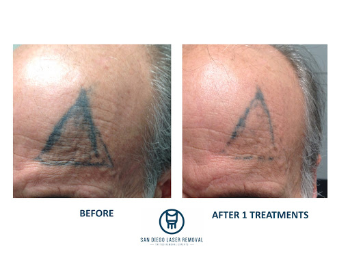 Explore depression semicolon tattoo ideas, creative tattoo ideas in San Diego, available at Removery Tattoo Removal & Fading