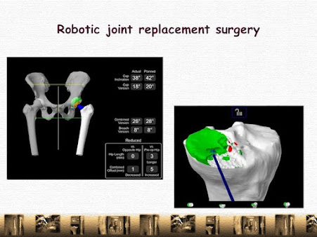 جراحة إنقاذ الأطراف وتقويم المفاصل - Limb Salvage and Revision Arthroplasty Surgery