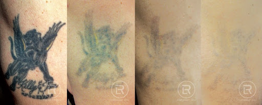 Explore skull and crossbones tattoo ideas, creative tattoo ideas in Minneapolis, available at Renewal Laser Clinic