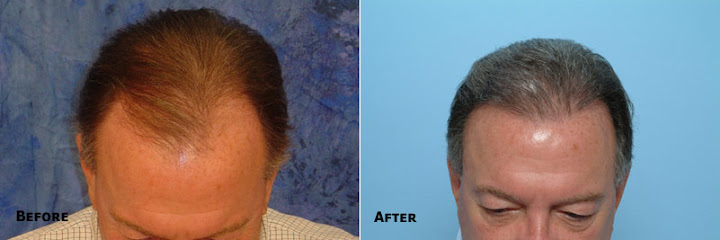 Central Florida Hair Restoration