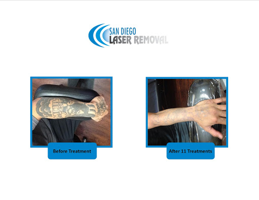 Explore tattoo ideas scorpio, creative tattoo ideas in San Diego, available at Removery Tattoo Removal & Fading