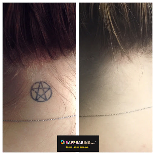 Explore dragon sleeve tattoo ideas, creative tattoo ideas in Northampton, available at Removery Tattoo Removal & Fading