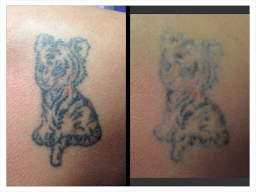 Explore eating disorder tattoo ideas, creative tattoo ideas in Colleyville, available at DFW Tattoo Removal