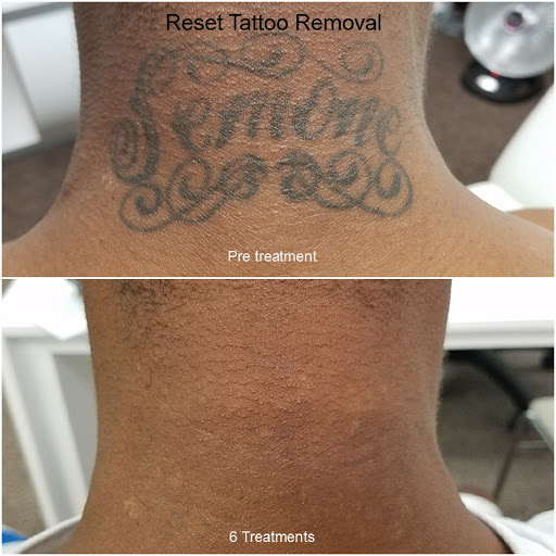 Tattoo removal service Paradise