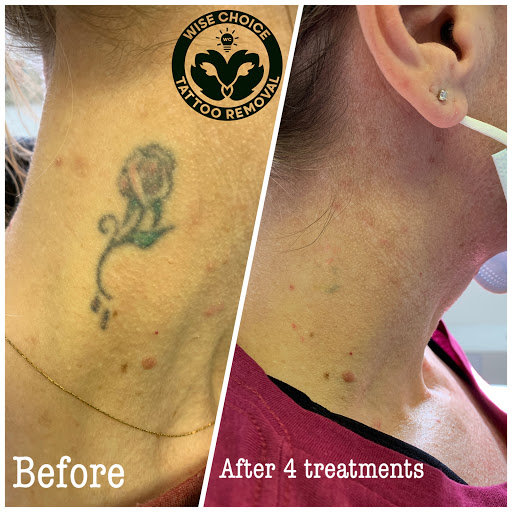 Explore sublime tattoo ideas, creative tattoo ideas in Denver, available at Wise Choice Tattoo Removal