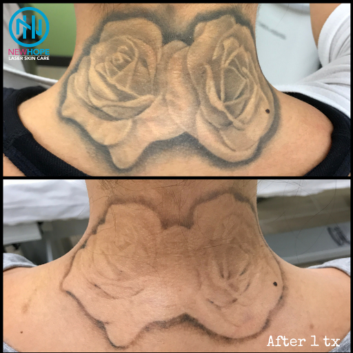 Explore abstract tattoo ideas, creative tattoo ideas in Westminster, available at Newhope Laser Skin Care