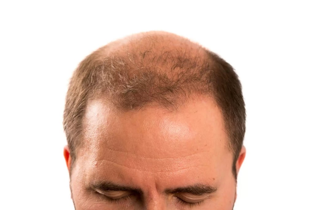Neograft Hair Restoration Orange County 92660