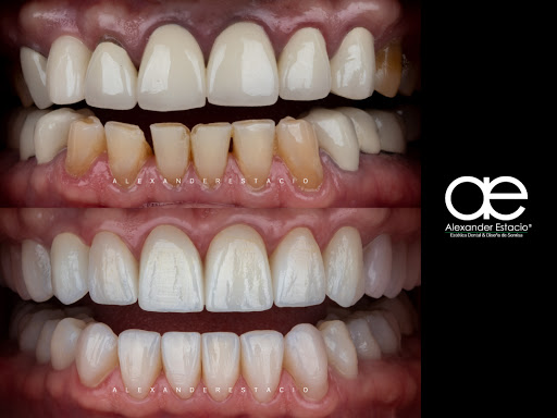 Alexander Estacio - Estética Dental & Diseño De Sonrisa