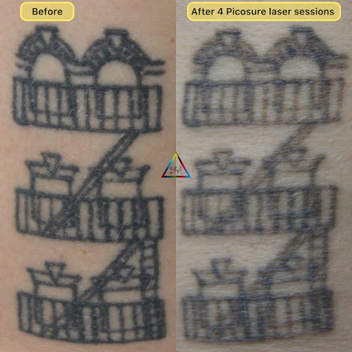 Explore emma tattoo ideas, creative tattoo ideas in New York, available at Ag2g Laser Tattoo Removal & MedSpa