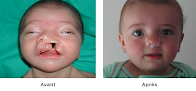 Cleft lip specialists Toulouse