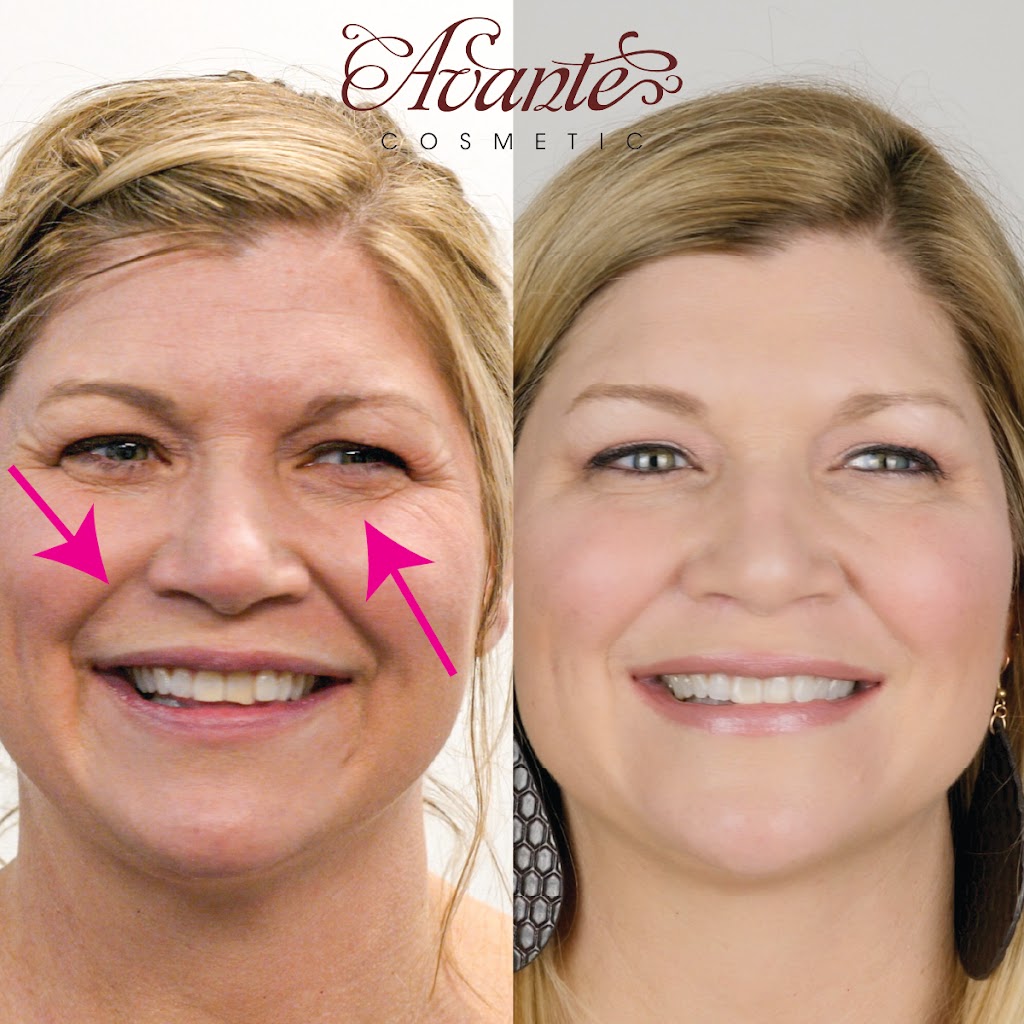 Avante Cosmetic 80209
