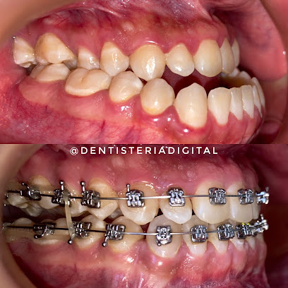 Dentistería Digital - Ortodoncia Invisible Invisalign