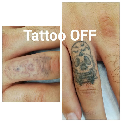 Tattoo OFF Bucuresti