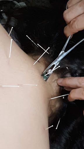 Acupuncture Clinic «Eternal Health & Wellness», reviews and photos, 1066 Saratoga Ave #100, San Jose, CA 95129, USA