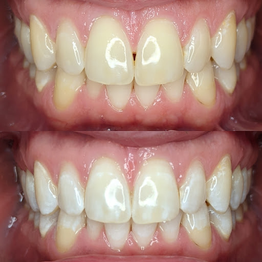 WYTR Professional Teeth Whitening