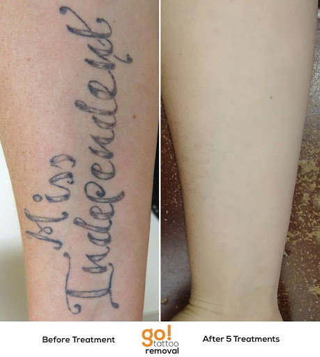 Explore lining tattoo ideas, creative tattoo ideas in Allentown, available at Removery Tattoo Removal & Fading