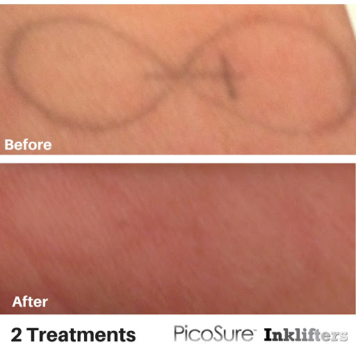 Explore eevee tattoo ideas, creative tattoo ideas in Pleasant Grove, available at Inklifters Tattoo Removal