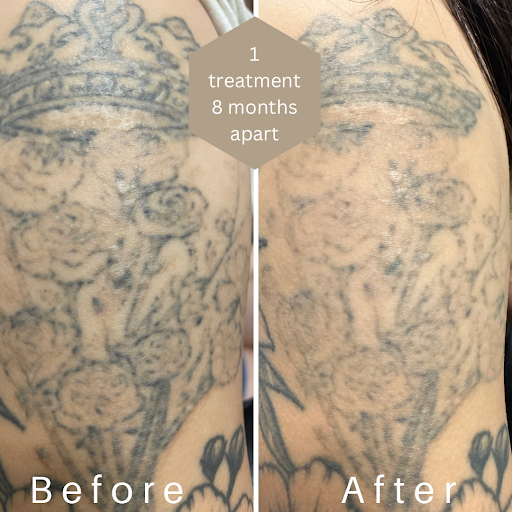 Explore tattoo ideas for feet and ankles, creative tattoo ideas in Mckinney, available at Premier Tattoo Removal