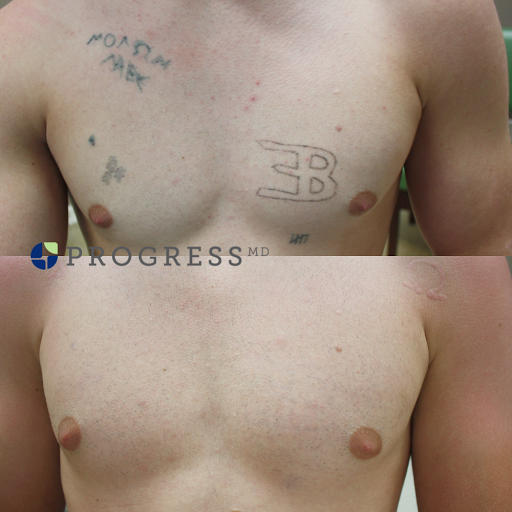 Explore back tattoo placement ideas, creative tattoo ideas in Amarillo, available at Progress MD Tattoo Removal
