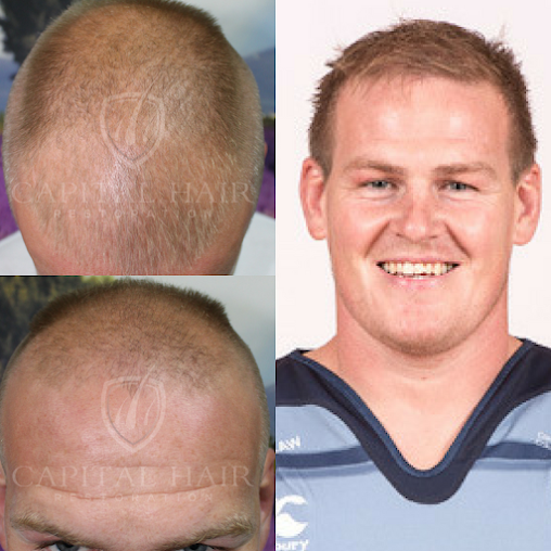UK Hair Transplant Clinics Chelmsford - UK Hair Transplant Clinics Chelmsford