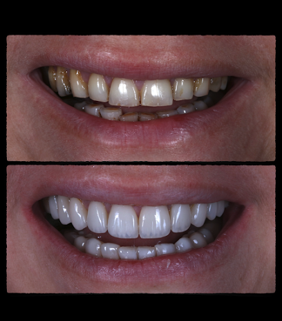 Karaçor Clinics | Smile Design | Laminate Veneer | Emax | Implant | Dentist | Adem Can Karaçor | Olcay Bakar | Kerem Karaçor