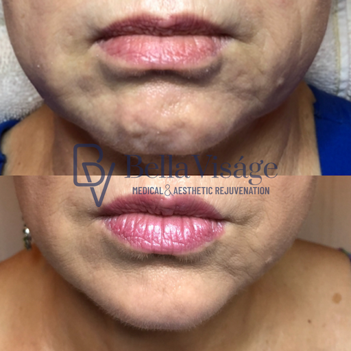 Explore tattoo ideas on the shoulder, creative tattoo ideas in Lakeland, available at Bella Visge Medical & Aesthetic Rejuvenation