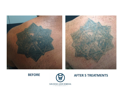 Explore women's hip tattoo ideas, creative tattoo ideas in San Diego, available at Removery Tattoo Removal & Fading