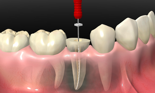 Periodoncista de implantes dentales Guadalupe