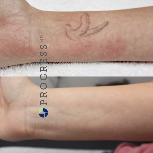 Explore scarlet witch tattoo ideas, creative tattoo ideas in Amarillo, available at Progress MD Tattoo Removal
