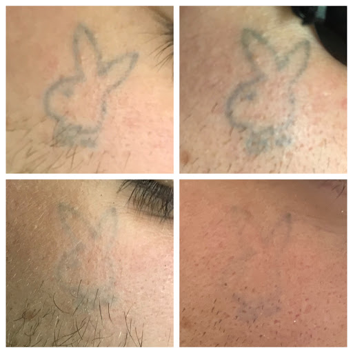 Explore patchwork tattoo ideas, creative tattoo ideas in Allen, available at Shipers Laser Tattoo Removal Center Dallas