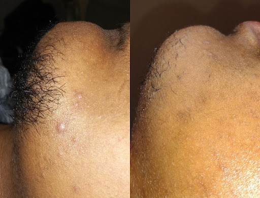 Explore big cover up tattoo ideas, creative tattoo ideas in Des Moines, available at Bare Beaute Permanent Hair Removal By Electrolysis, LLC