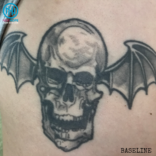 Explore small cover up tattoo ideas, creative tattoo ideas in Westminster, available at Newhope Laser Skin Care