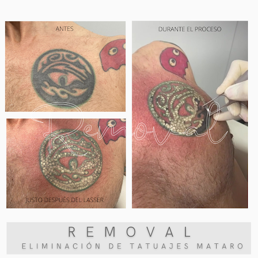 Removal eliminación de tatuajes Mataró