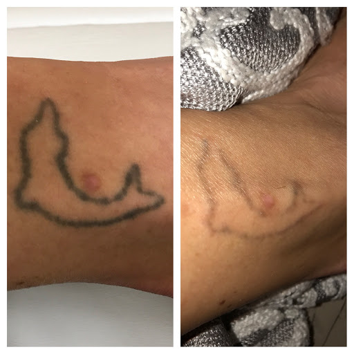 Explore march birthday tattoo ideas, creative tattoo ideas in Greenwood, available at Laser and Light Surgery Center