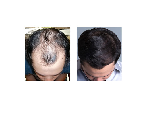 Bosley - Hair Restoration & Transplant