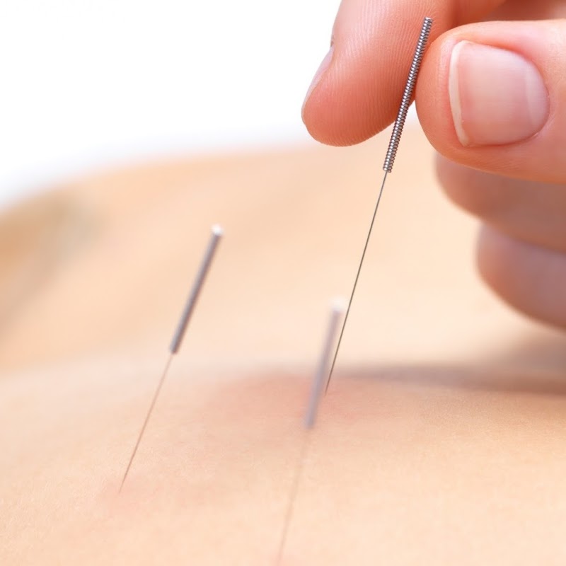 Peel Back Care Clinic - Dry Needling & Remedial Massage