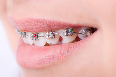 Azur Orthodontics - matériel orthodontie à Hyères