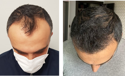 VIVAEST Hair Transplant Antalya - Клиника по пересадке волос Анталья - Saç Ekimi