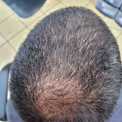 Top of the line scalp micropigmentation